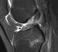 ACL MRI Rupture T2